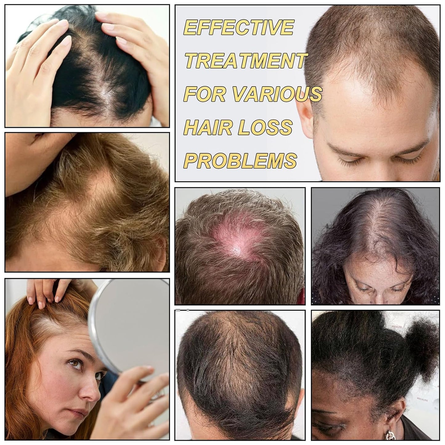 5% Minoxidil for Men and Women Hair Growth Serum, Biotin Hair Growth, Hair Regrowth Treatment for Scalp Hair Loss Hair Thinning for Thicker Longer Fuller Healthier Hair (Pack of 1)